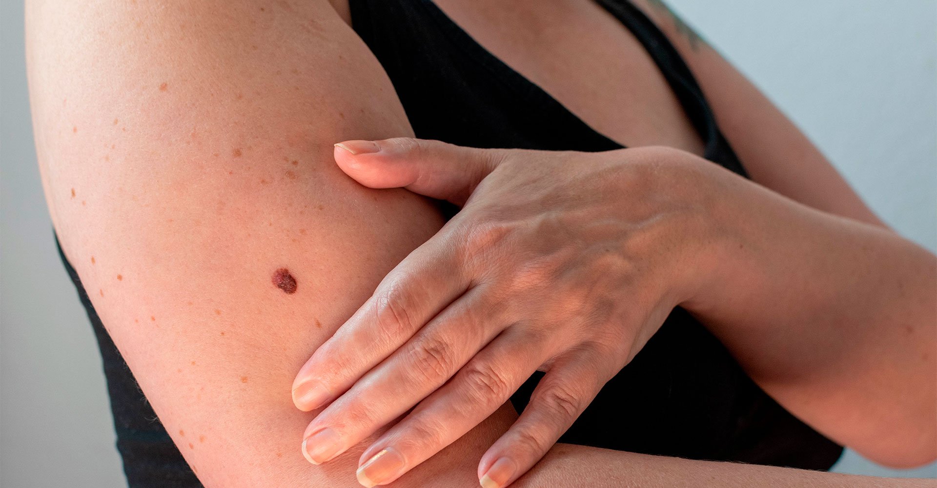 Câncer de pele: dermatologista fala o que é e como prevenir